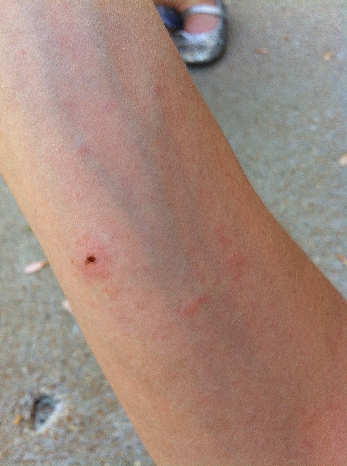 The End of the Poison Ivy Saga. With Pics! Charisa Darling