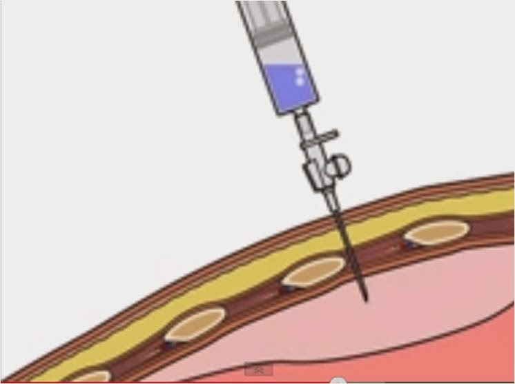 Phimaimedicine 2,631 Needle aspiration of primary spontaneous pneumothorax