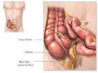 Nursing Care Plan for Appendicitis Post Operative