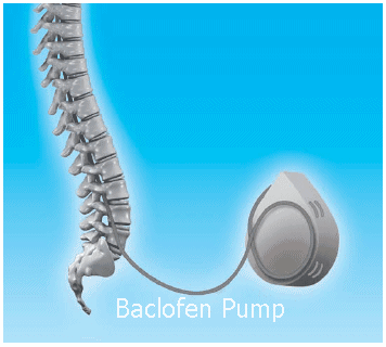 Physiotherapy JOBS: Baclofen Pump combined with Physiotherapy is a Life