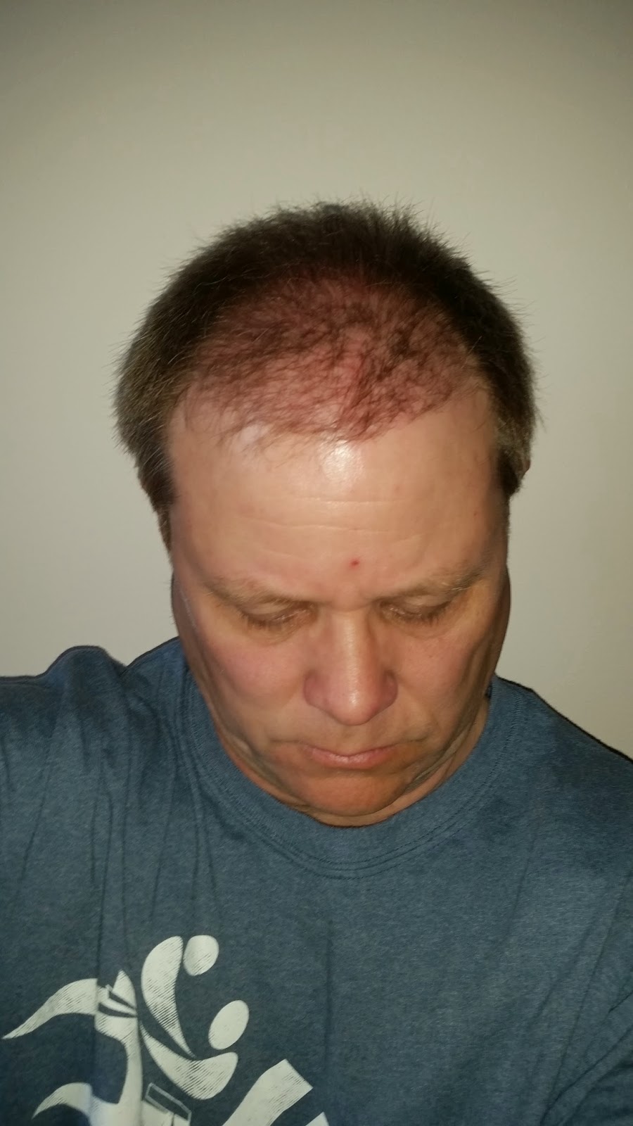 My FUE Hair Transplant 12 Weeks Since My 2nd FUE Hair Transplant