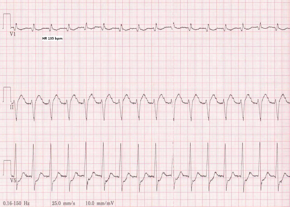 Tachycardia, Ectopic Junctional; Ectopic Junctional Tachycardia