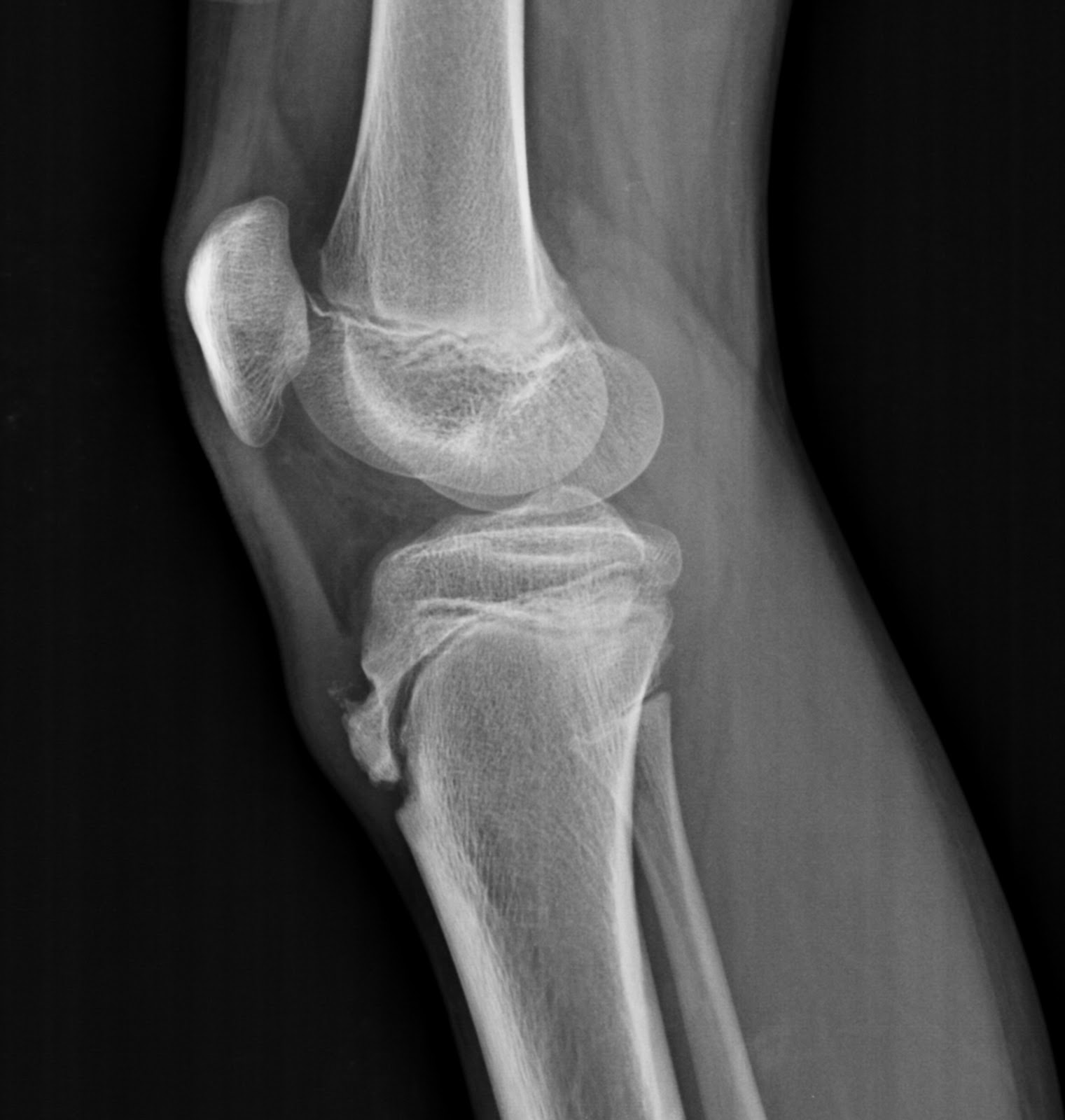OsgoodSchlatter disease The Third Eye Radiology site
