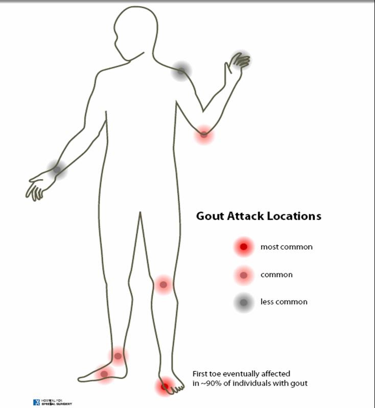 HEALTH FROM TRUSTED SOURCES Gout