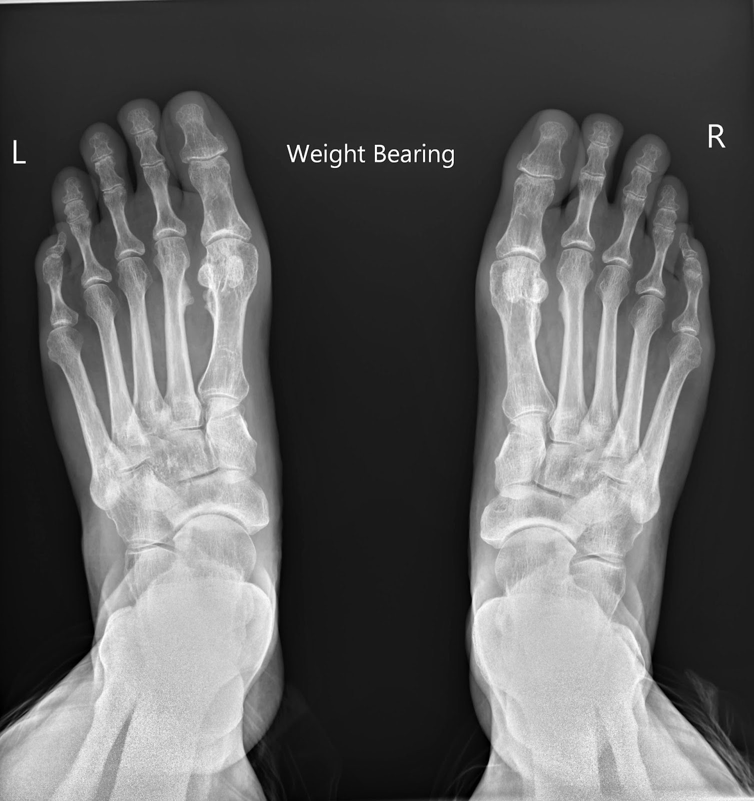 Margaret River Correspondent Bunions, New Xrays, 2 Years and 1 Month