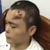 Cirujanos chinos cultivan una nariz en la frente de un paciente 