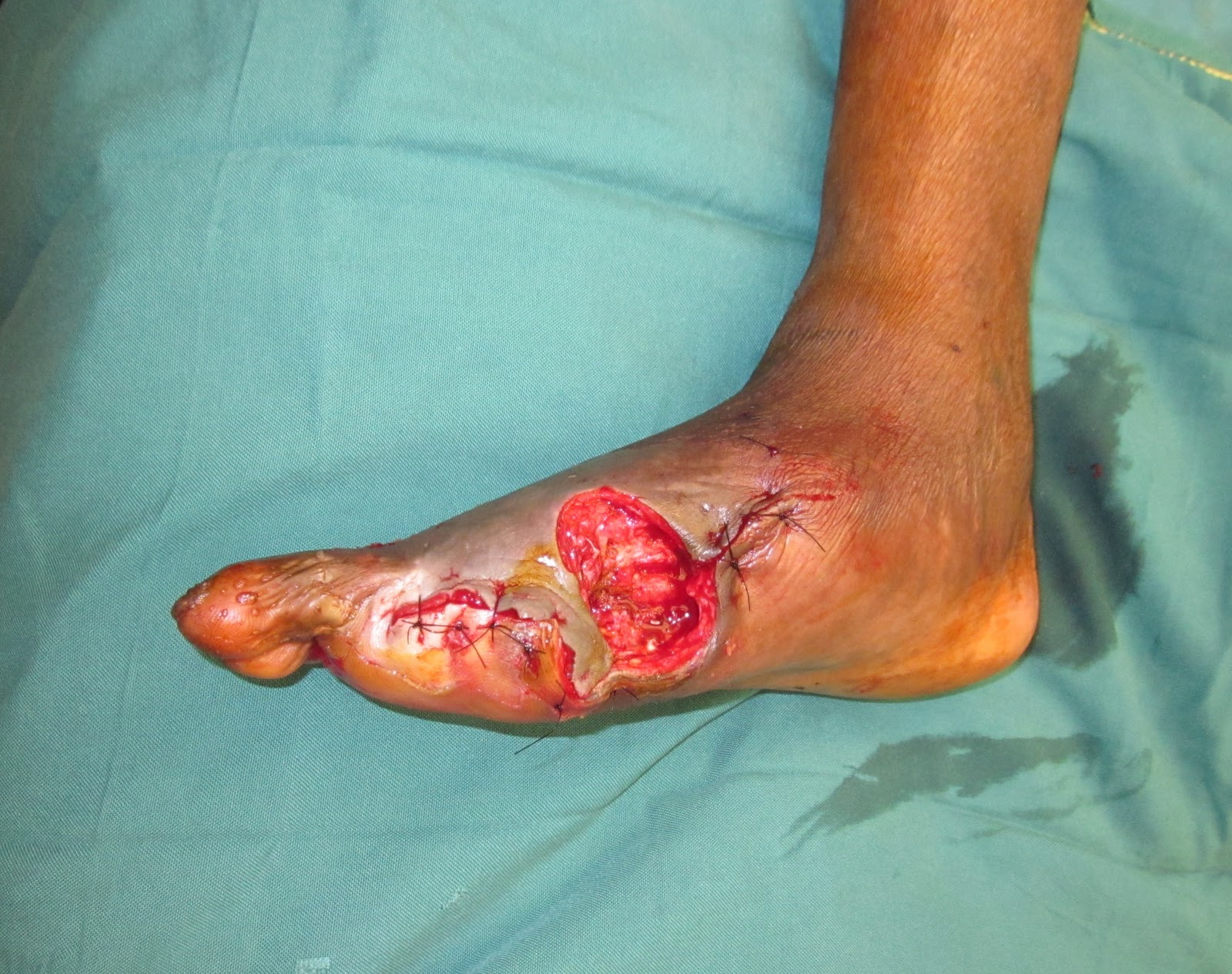 Wet Gangrene Toe