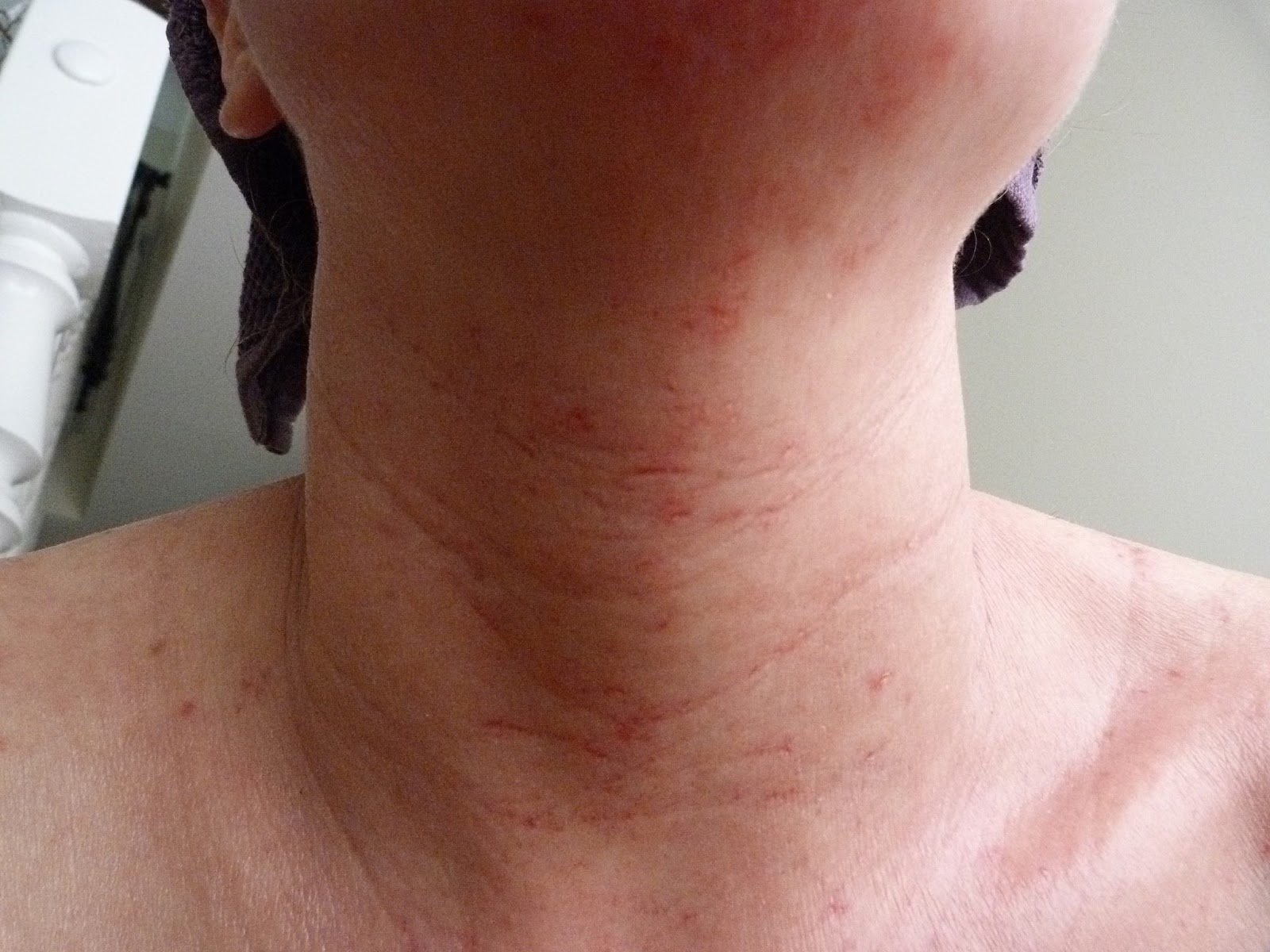 I Have Eczema 26th June 2013 TSW