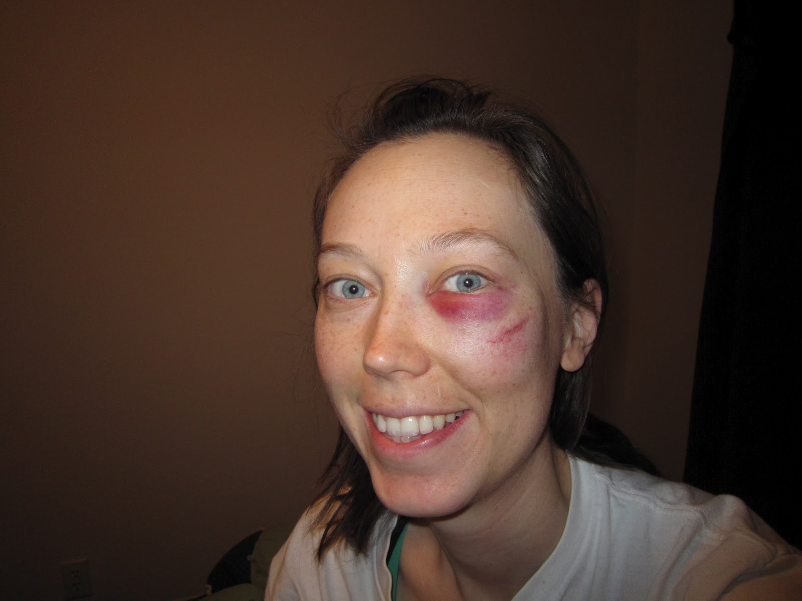 befuddled bug's blog of bewilderment My First Black Eye!!!