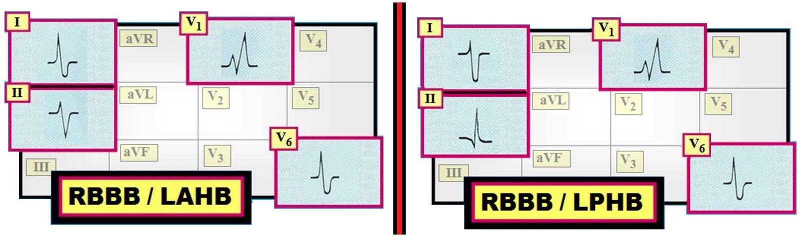 Bifascicular Block Ekg