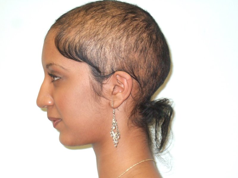 hair loss treatment cost