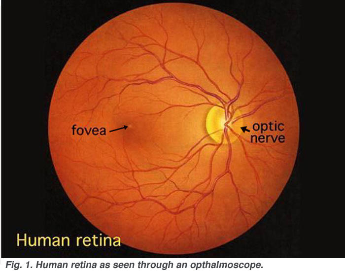Dr.EDUARDO BERCOVICH Dibetes tipo 1 Complicaciones Crónicas, Retinopatía