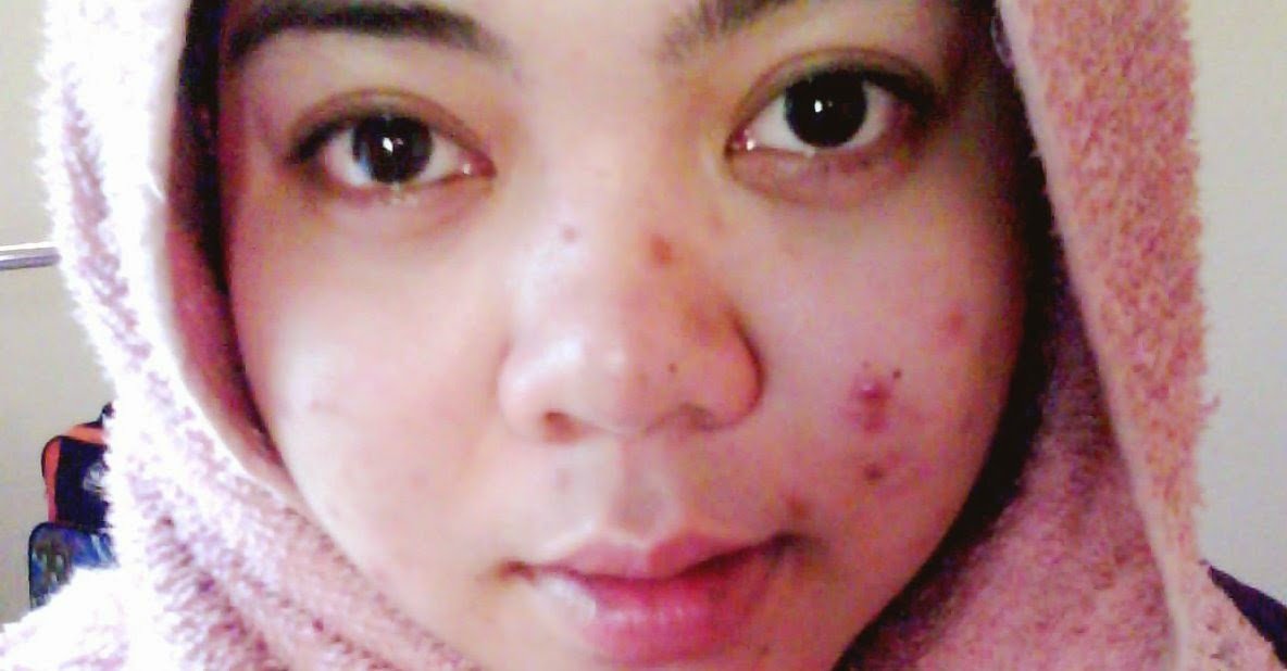 Cara Menghilangkan Jerawat Batu Dengan Mudah Cepat Dan Alami Unik Menarik Misteri Lucu Wakakak Cara Menghilangkan Jerawat Batu Dengan Mudah Cepat Dan Alami Unik Menarik Misteri Lucu Wakakak