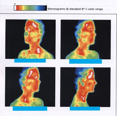 Hyperthermia above the level of resection (thermoregulatory dysfunction) as a side-effect of ETS