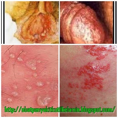 Penyakit Herpes Penyakit Herpes
