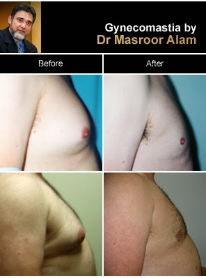 Before and After Gynecomastia Photos