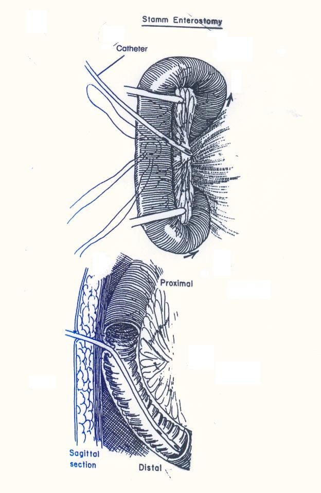 OTMANAGE PROCEDURES 5 Jejunostomy