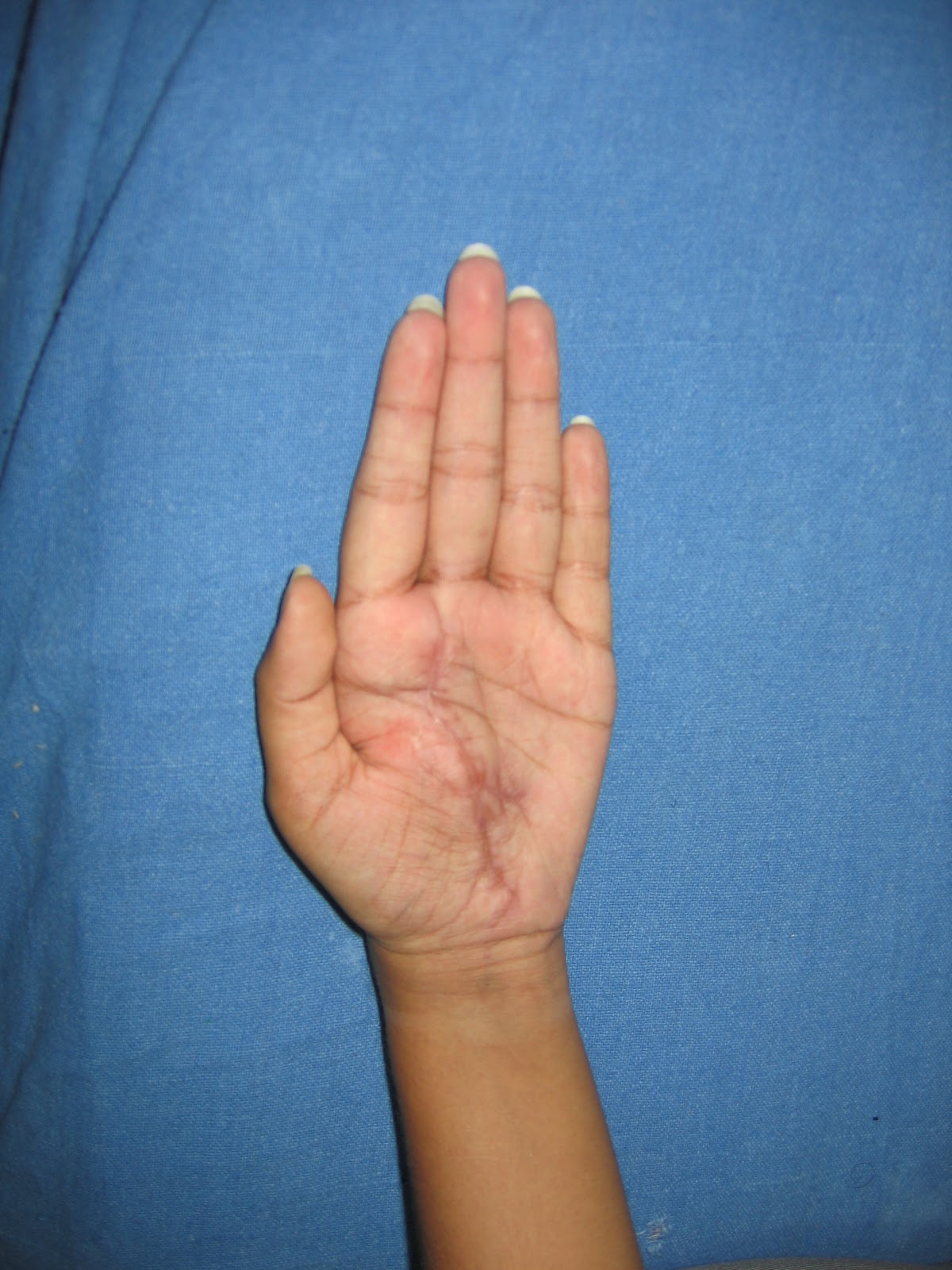 CRUSH INJURIES OF HAND AND UPPER LIMB INJURIES HAND TRAUMA