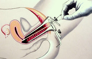 PAPANICOLAU - PAP Examen de Papanicolau PAP