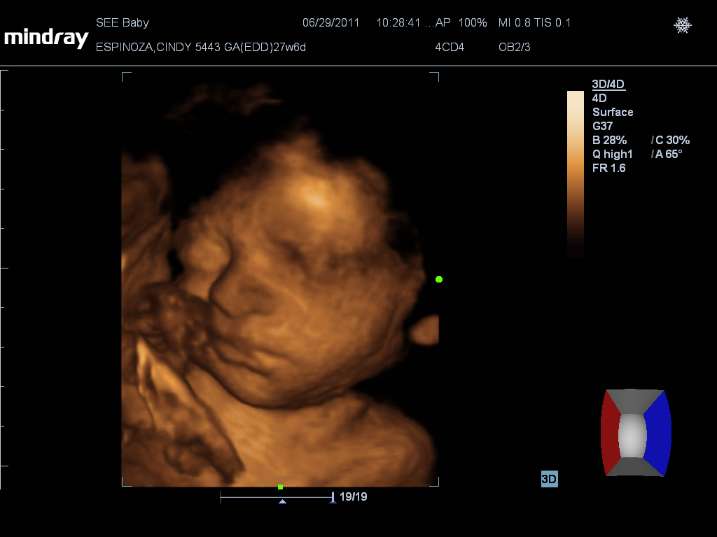 Viva Cindy 3d Ultrasound