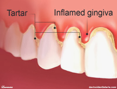gingivitis-radang-gusi gingivitis-radang-gusi