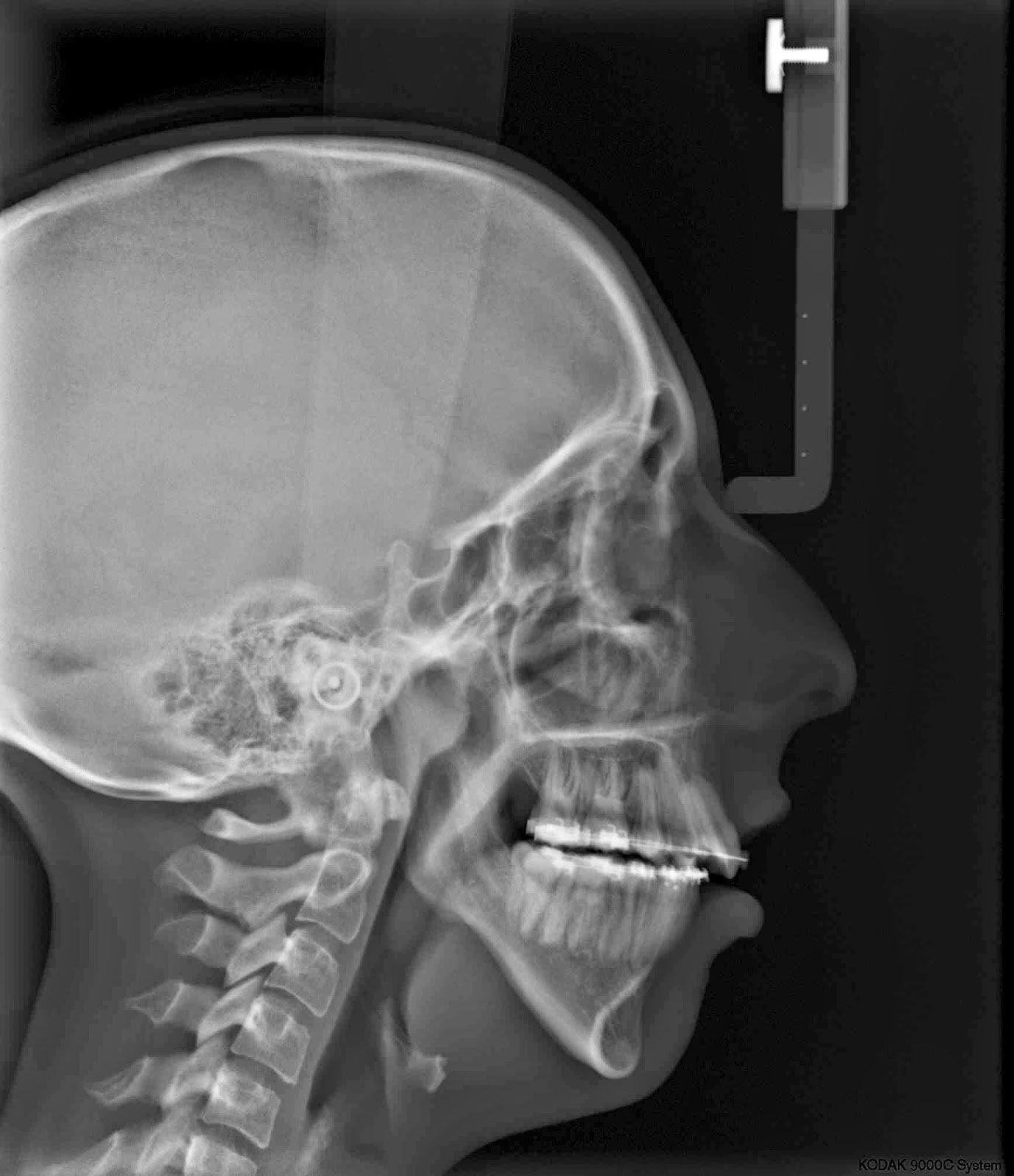 Double Jaw Surgery Journey PreSurgery XRays