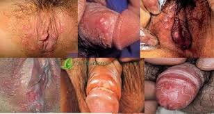Obat Sipilis Obat Sipilis