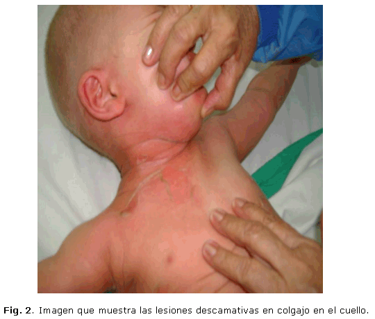 Atopichesky la dermatitis la clasificación el tratamiento