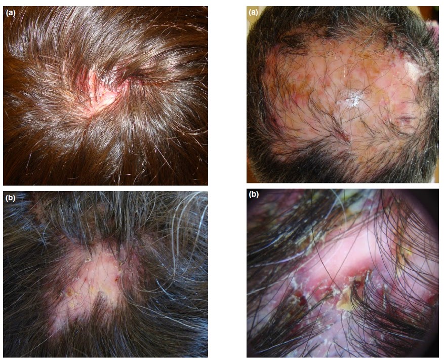 Dermapixel: Dermatitis seborreica: No es piel seca