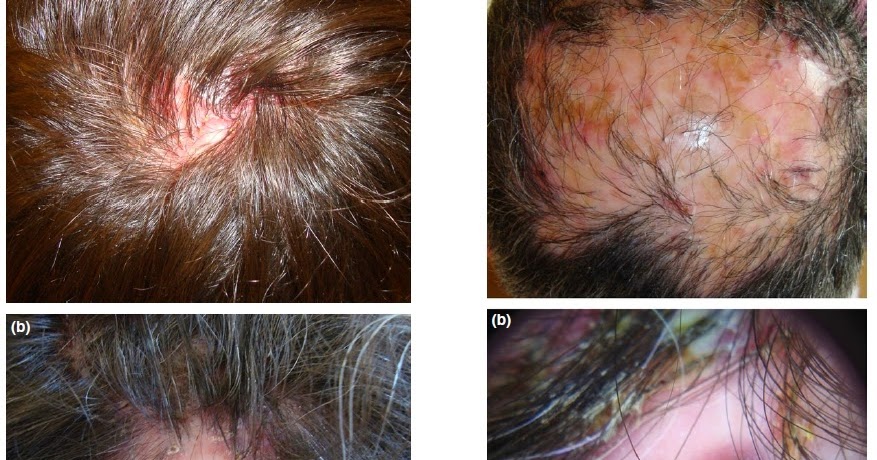 foliculitis cuero cabelludo dermatolog 237 a madrid foliculitis decalvante un tipo raro foliculitis cuero cabelludo dermatolog 237 a madrid foliculitis decalvante un tipo raro