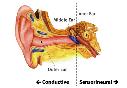 Sudden Deafness And Ringing Sudden Deafness And Ringing