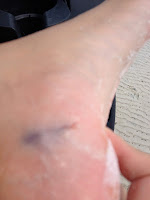 stingray sting aftermath tasty travels along way beach