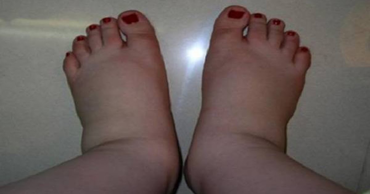 Are Your Legs Swollen? You Can Throw Out The Excess Water Of Your Body