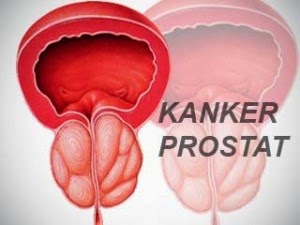 obat kanker Prostat alami stadium 4, obat kanker prostat, pengobatan kanker prostat