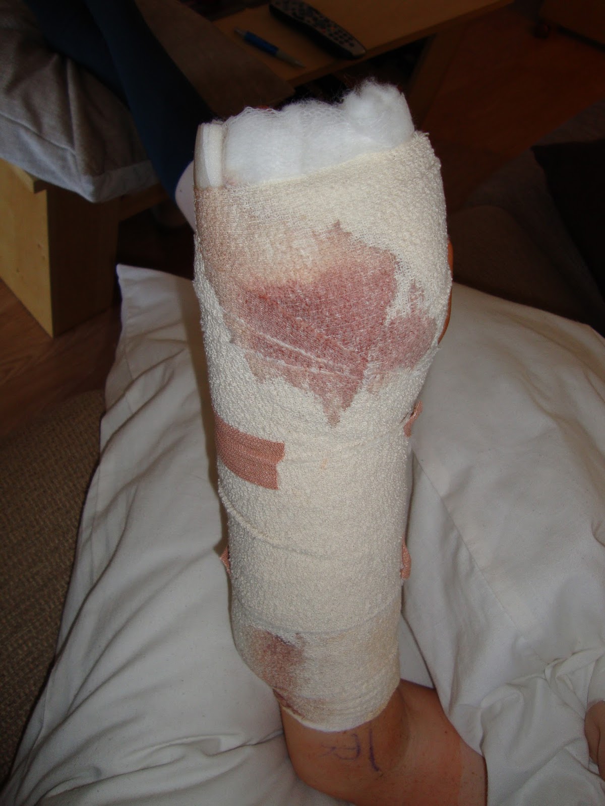 Gwen's Feet (and Hand) Knuckle Replacement Day!