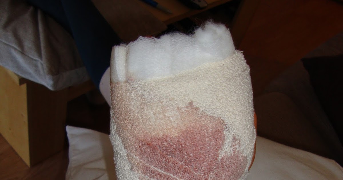 Gwen's Feet (and Hand) Knuckle Replacement Day!