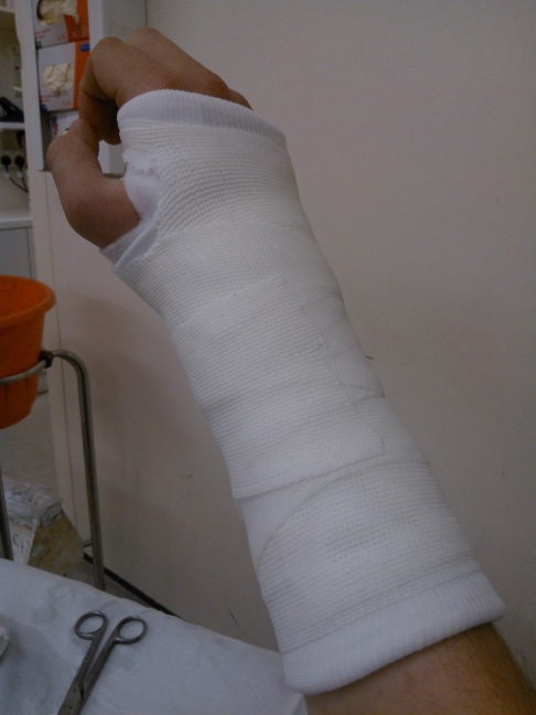 broken wrist fizzeo – what should I expect?? – Singletrack Magazine