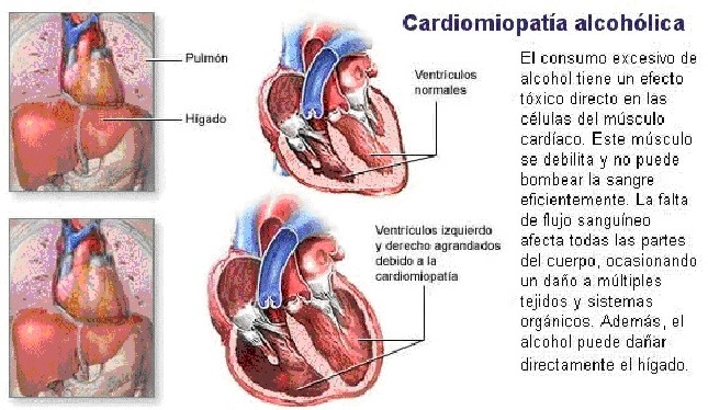 La codificación del alcohol en novokuznetske