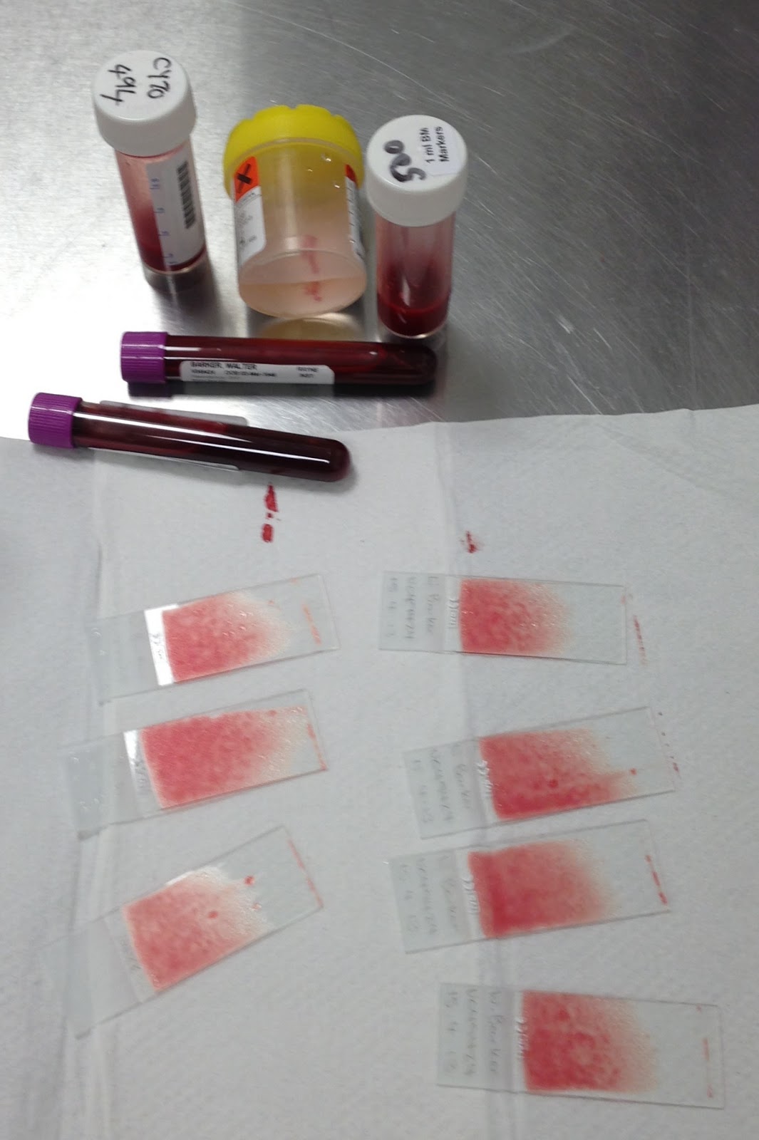 Bone marrow test results explained picture