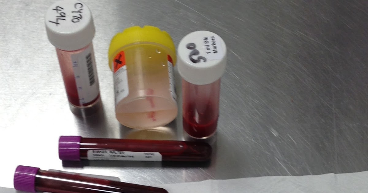 MDS in the family Bone Marrow test and Clinic at Kings