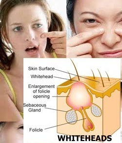Whiteheads How to Remove Whiteheads
