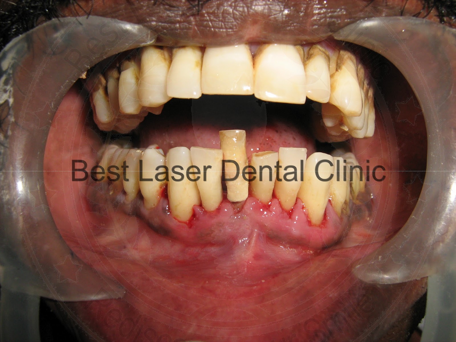 » gallery 2Immediate extraction and NEW TOOTH replacement of single