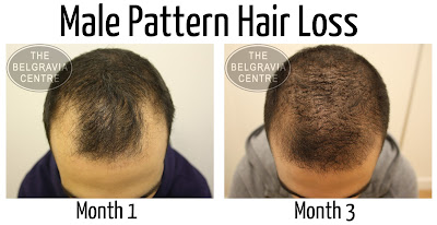how does the belgravia centre treat male hair loss no fall hair