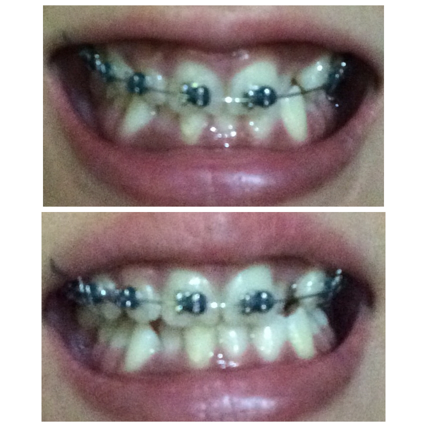 Braces Smile Removable Bite Plate