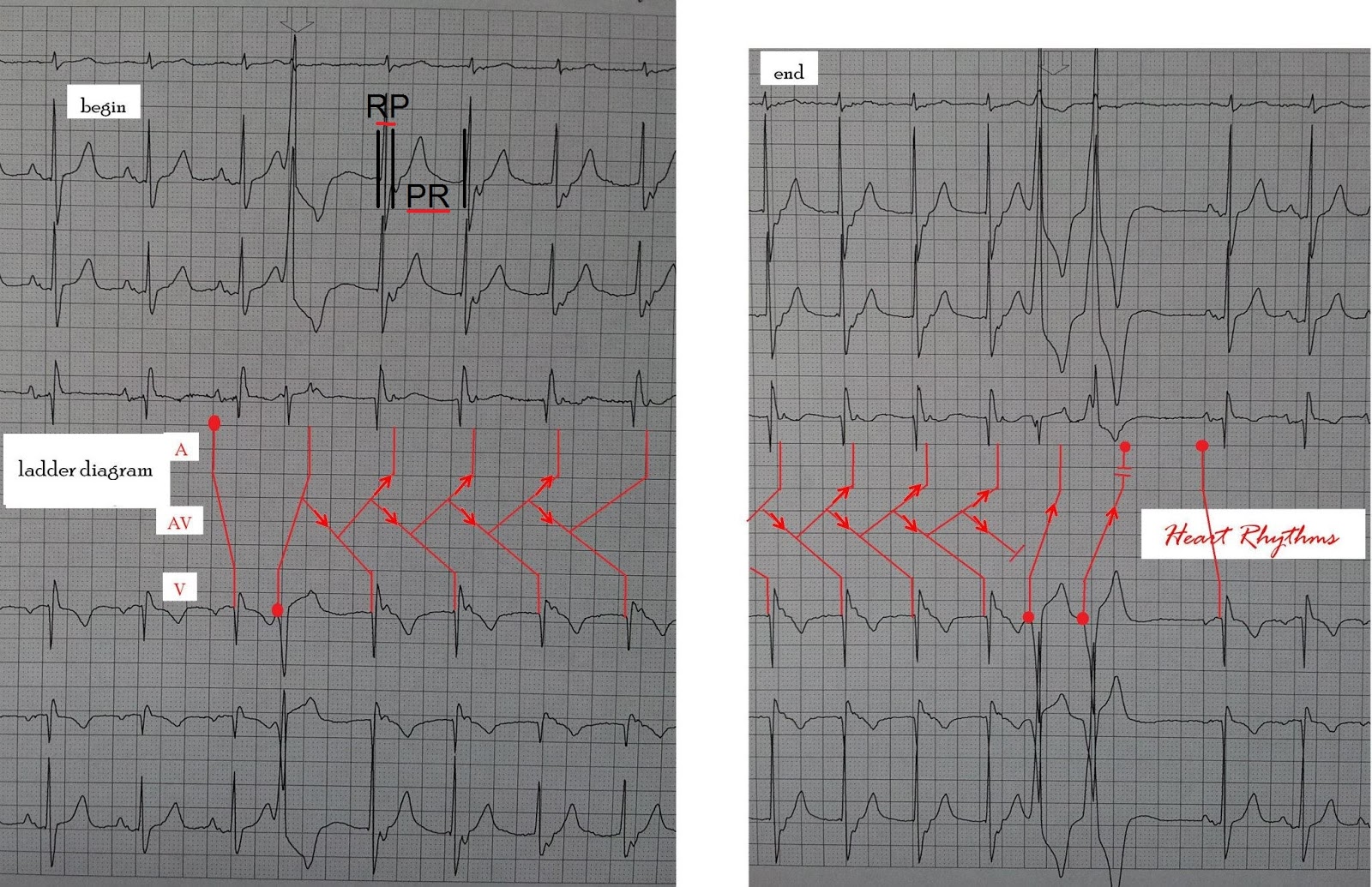ECG Rhythms A reentry phenomenon