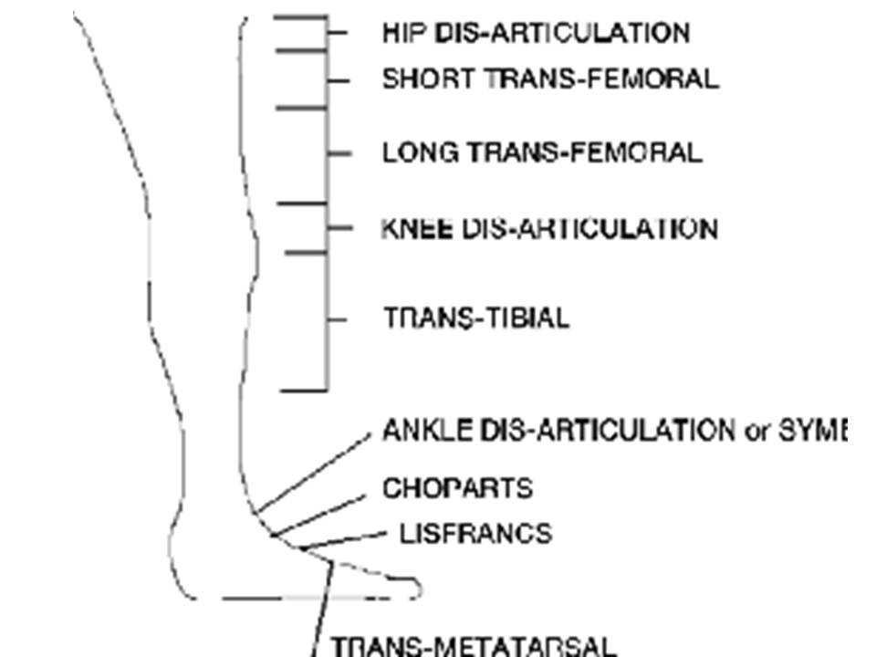 Fathia Arsyiana Below Knee Amputation