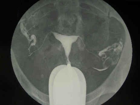 ABC Radiology Blog: Hysterosalpingogram