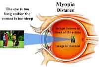 Gaya Hidup Mempengaruhi Terjadinya Mata Myopia