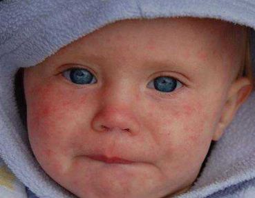 Jika Anak Menderita Campak - HEALTHYNESIA - Blog Info Sehat