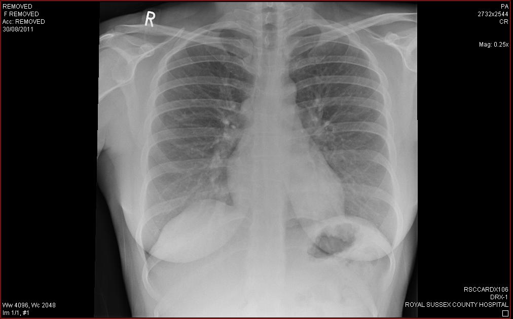 My Brother, My Kidney and I Pictures as promised